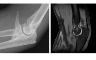 Rigidez de codo o codo rígido: causas, tratamiento y recuperación