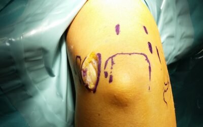 Atrapamiento del nervio cubital (neuropatía cubital): síntomas, pruebas, tratamiento y recuperación