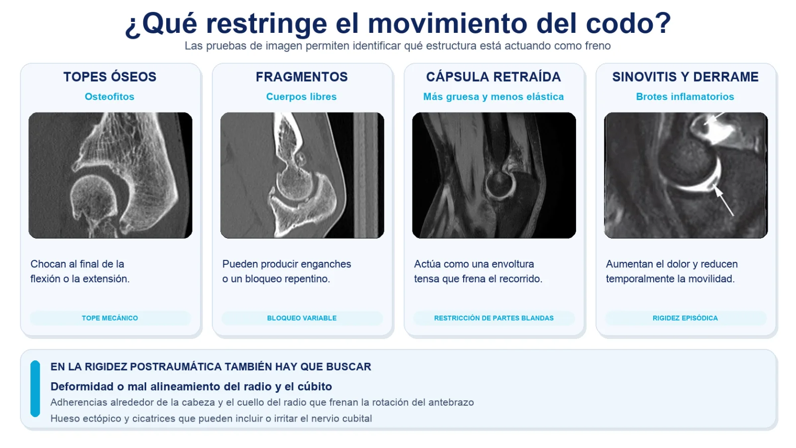 Infografía de qué restringe el movimiento del codo: topes óseos, fragmentos, cápsula retraída y sinovitis