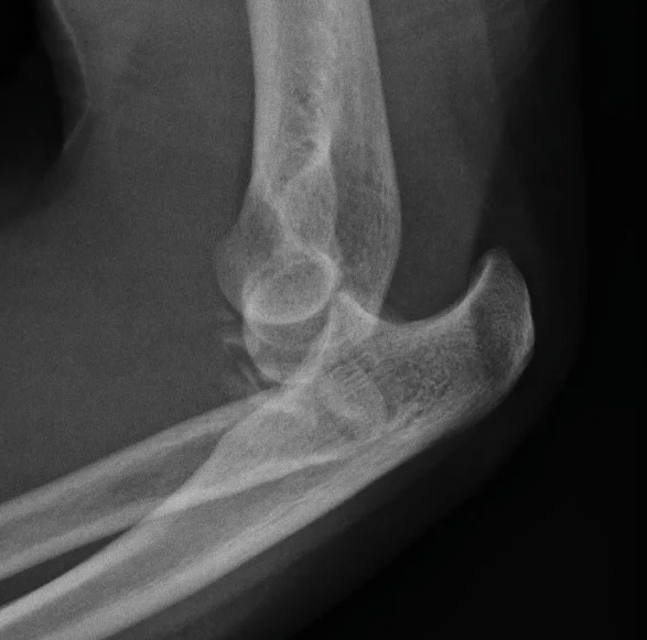 Radiografía lateral de luxación de codo con fractura asociada