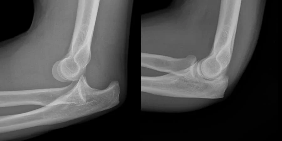 Radiografías laterales de una luxación de codo antes y después de la reducción