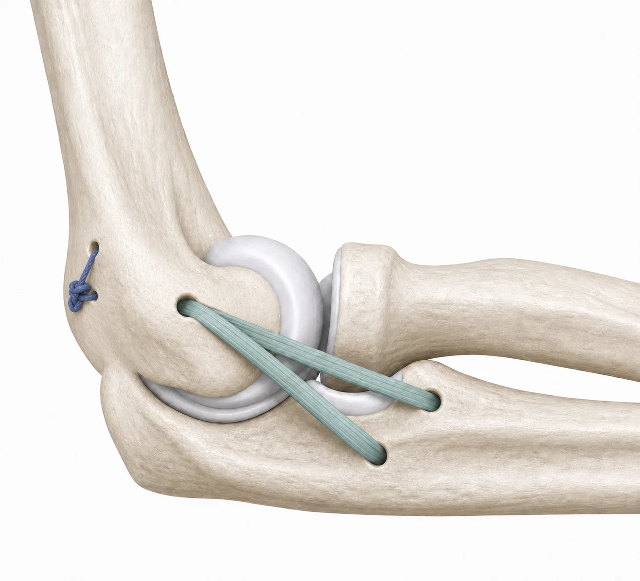 Reconstrucción del ligamento colateral lateral del codo