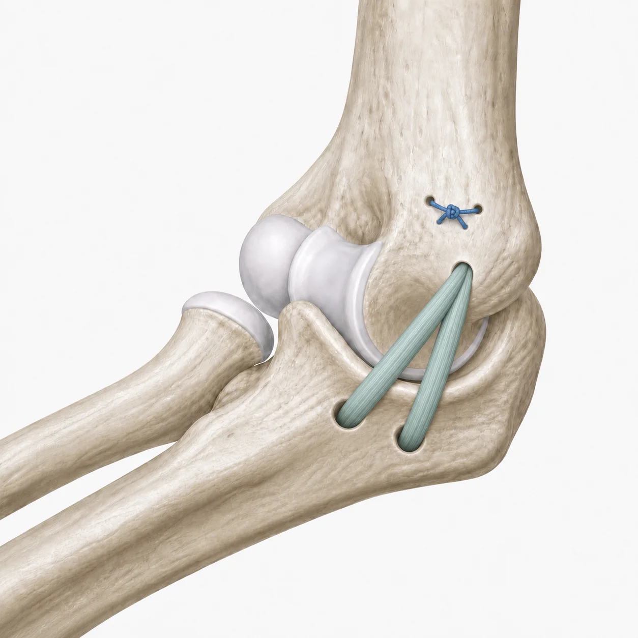 Reconstrucción del ligamento colateral medial del codo